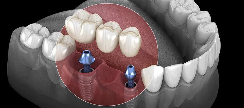 Representação de implantes dentários